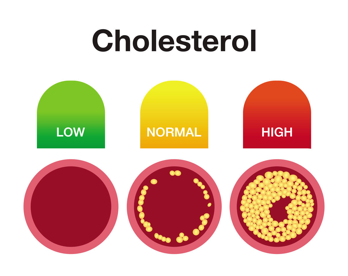 cholesterol levels and arteries clog