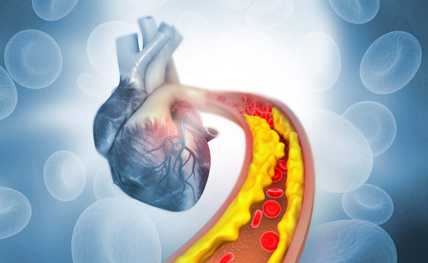 high cholesterol symptoms causes treatments