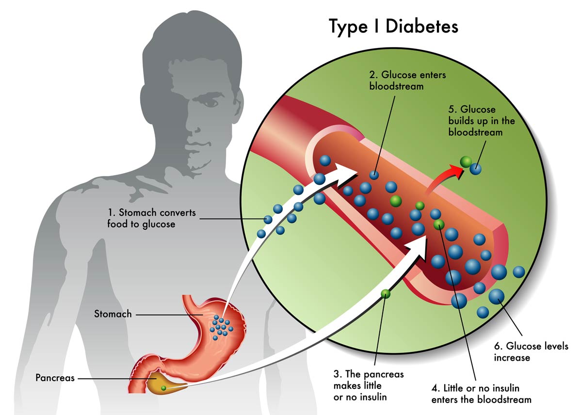 diabetes-type-1-explanation