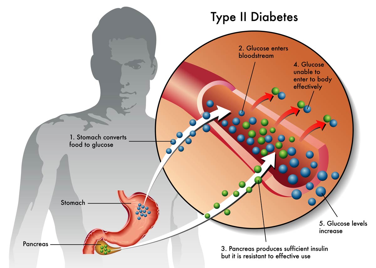 diabetes-type-2-explanation